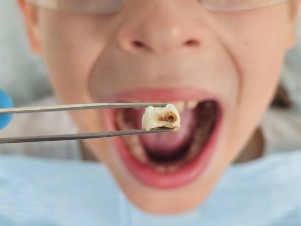 Best Broken or Cracked Tooth Emergency Dentist in Port Jefferson, NY